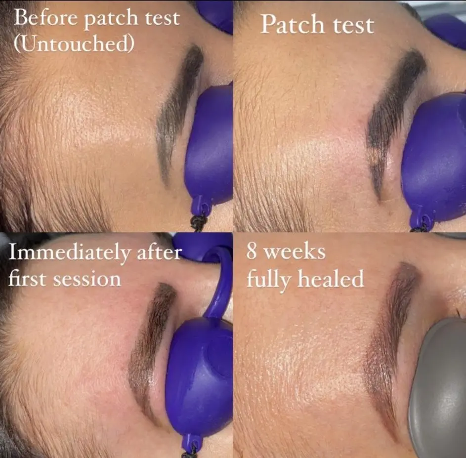 Brow tattoo removal 