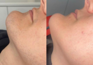 Where’s the Best Place for Trans People to Get Laser Hair Removal?