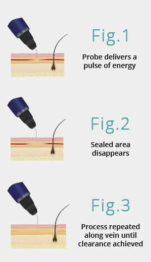 How Does Thermavein Work? 