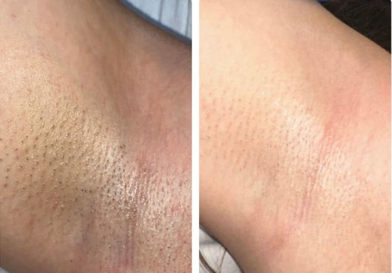 Skin Care No-Go’s for Laser Hair Removal