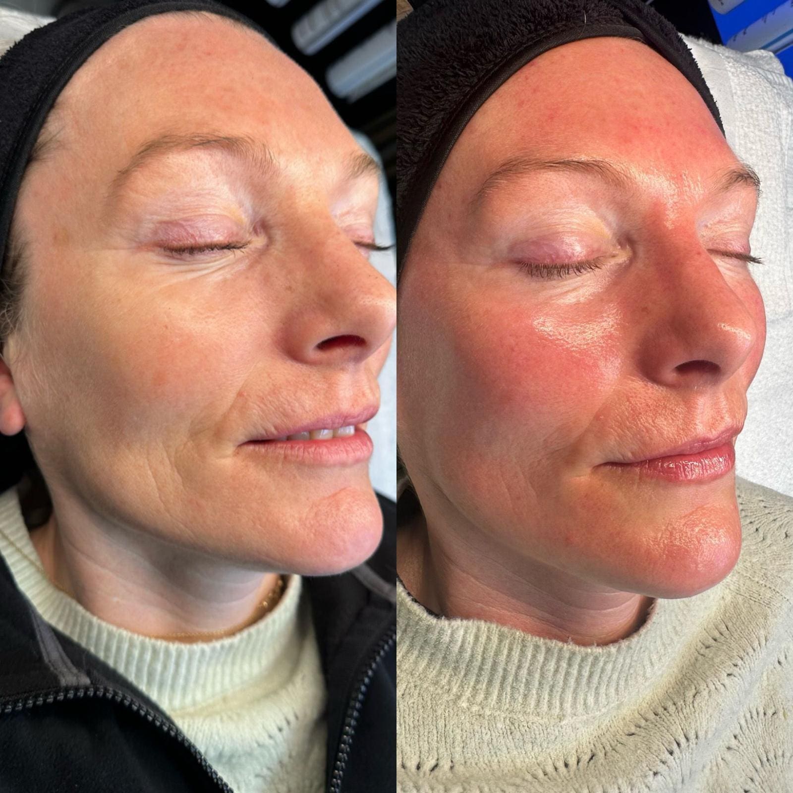 tattoo removal - Before and After 1