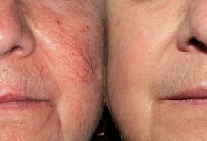 ThermaVein vs CryoPen