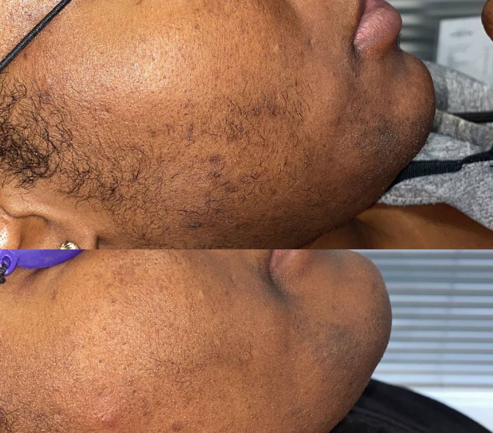 laser-hair-removal-for-dark-skin-1