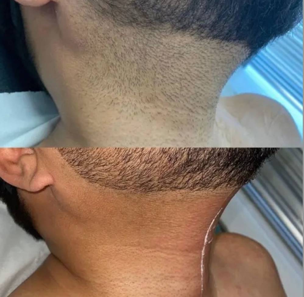 laser-hair-removal-for-dark-skin-2