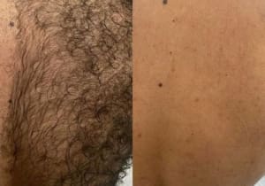 Is Laser Hair Removal Safe for Dark Skin?