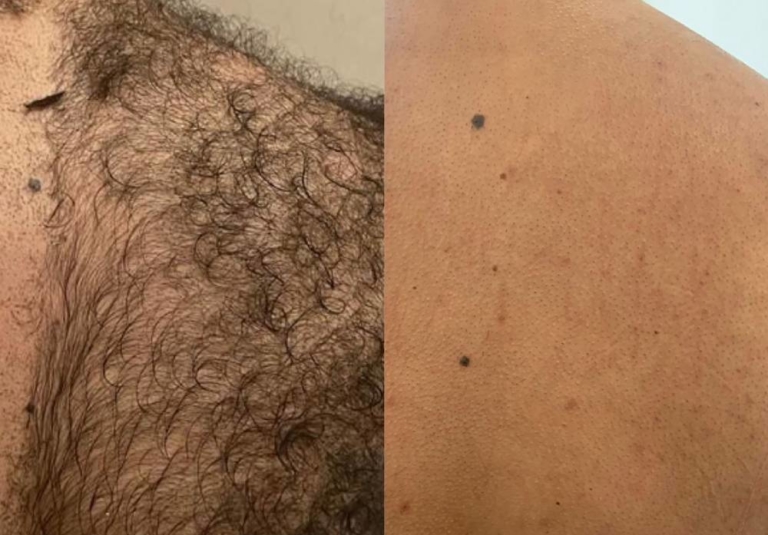 Is Laser Hair Removal Safe for Dark Skin?