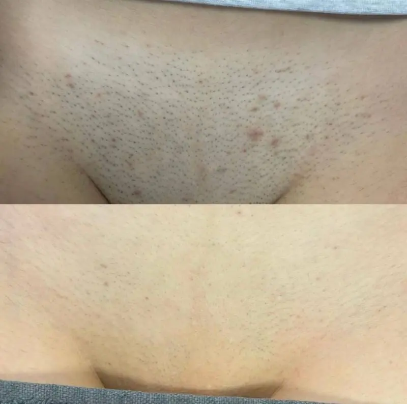 Laser Hair Removal Skin Reactions