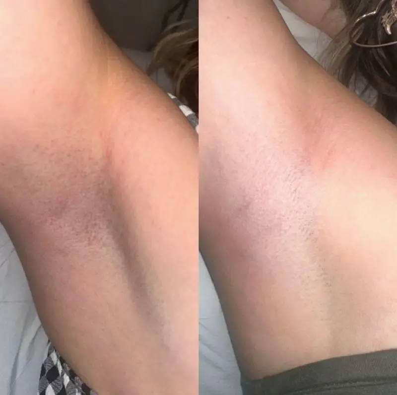 Laser Hair Removal Skin Reactions
