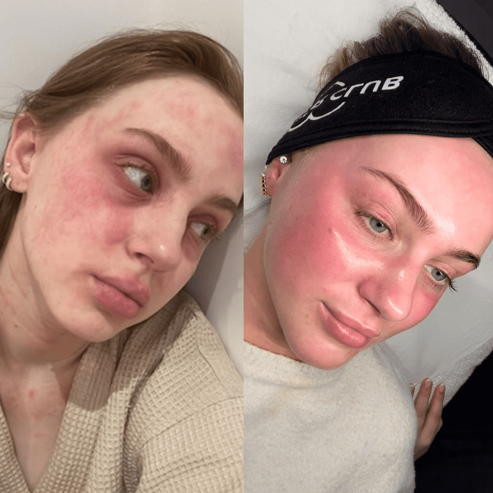 Microneedling Treatment Image