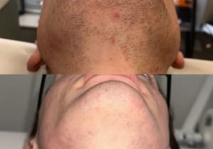 Is Laser Hair Removal Eco-Friendly — or Another Wasteful Beauty Trend?