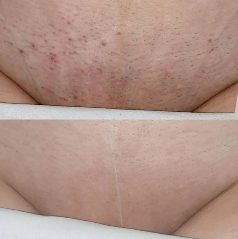 Teenagers and Laser Hair Removal