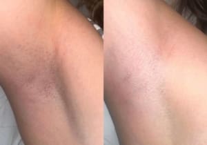 Teenagers and Laser Hair Removal