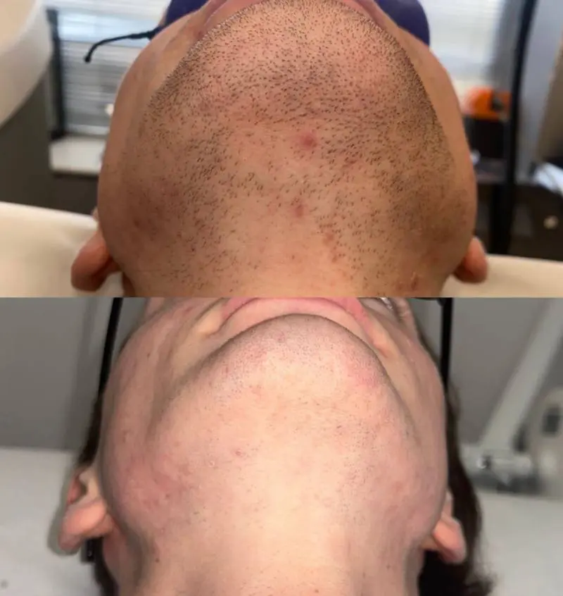 Teenagers and Laser Hair Removal