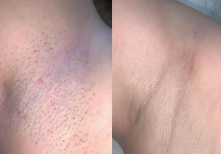 laser-hair-removal