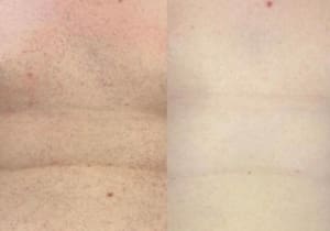 Why Men Are Still Hesitant About Laser Hair Removal – Toxic Masculinity or Market Gap