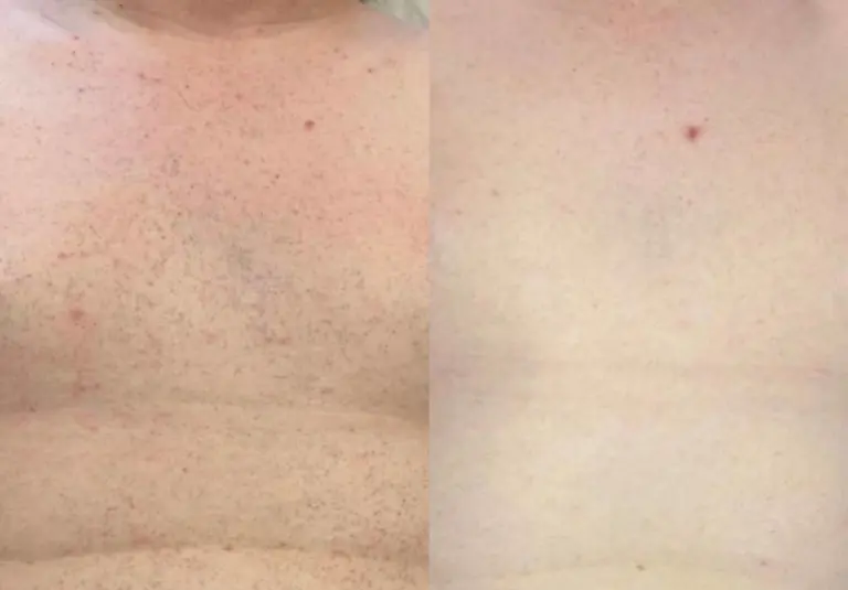 Men Hair Removal