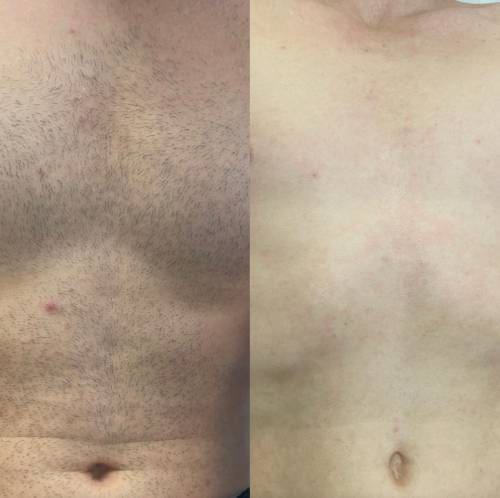 full torso 5 sessions