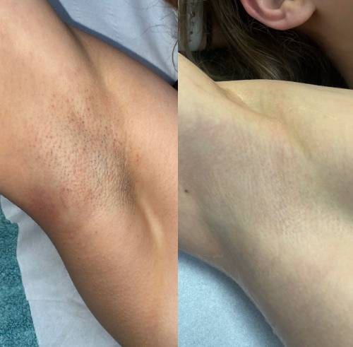 underarms 5 sessions