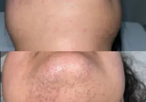 Is Permanent Hair Removal a Trend