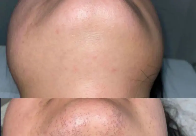 Is Permanent Hair Removal a Trend