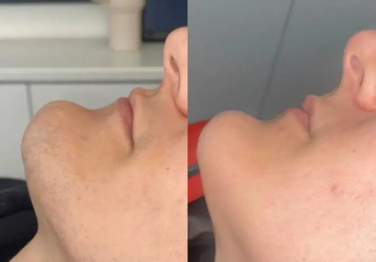Is Laser Hair Removal Safe for Teens