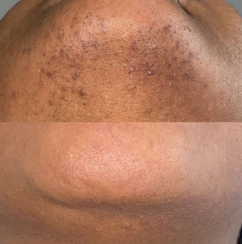 Is Laser Hair Removal Safe for Teens