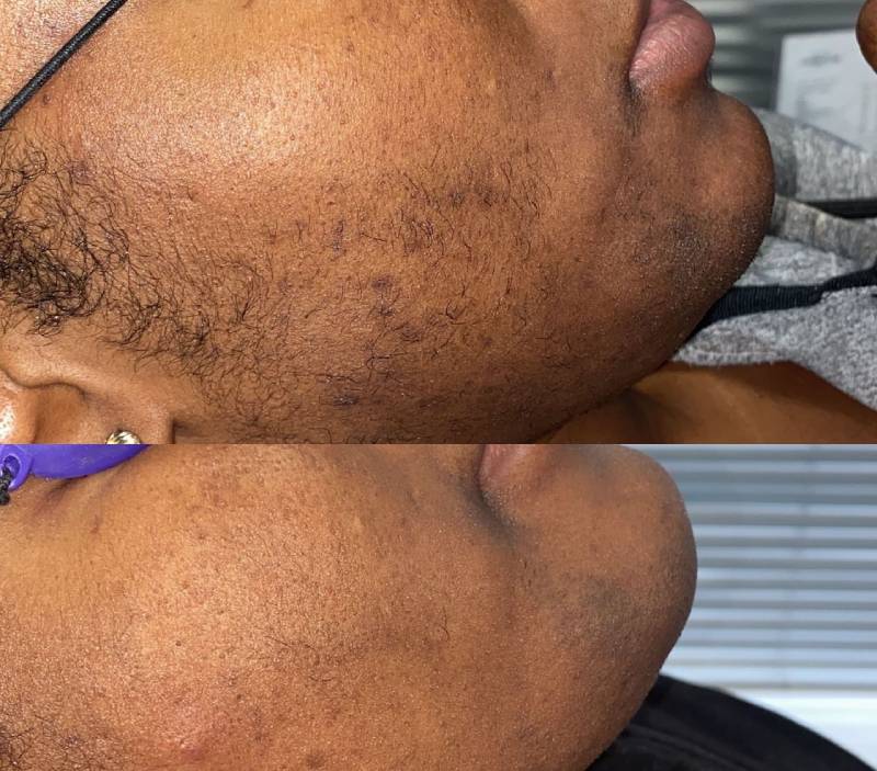 Are Darker Skin Tones Being Ignored by the Laser Hair Removal Industry