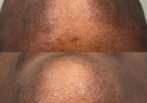 Are Darker Skin Tones Being Ignored by the Laser Hair Removal Industry