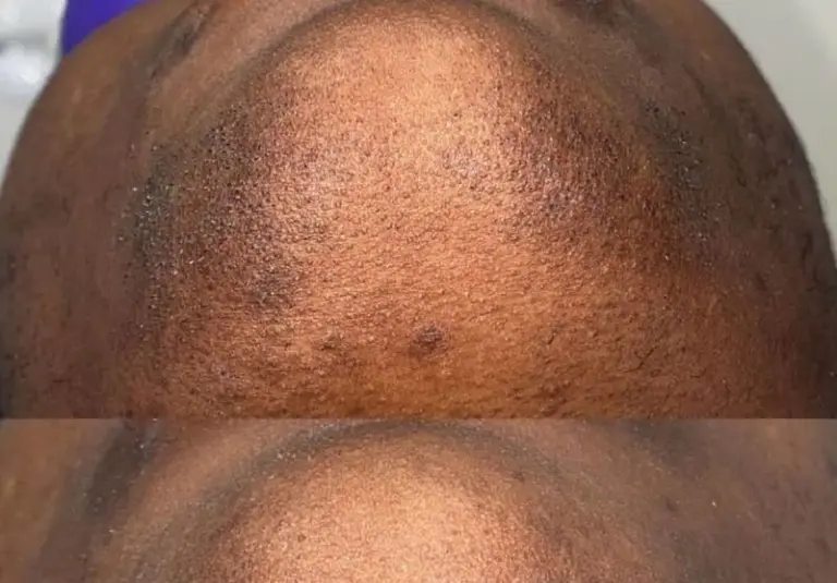 Are Darker Skin Tones Being Ignored by the Laser Hair Removal Industry
