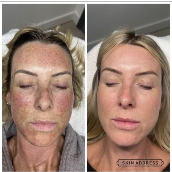 Photofabulous skin Treatment Cheshire