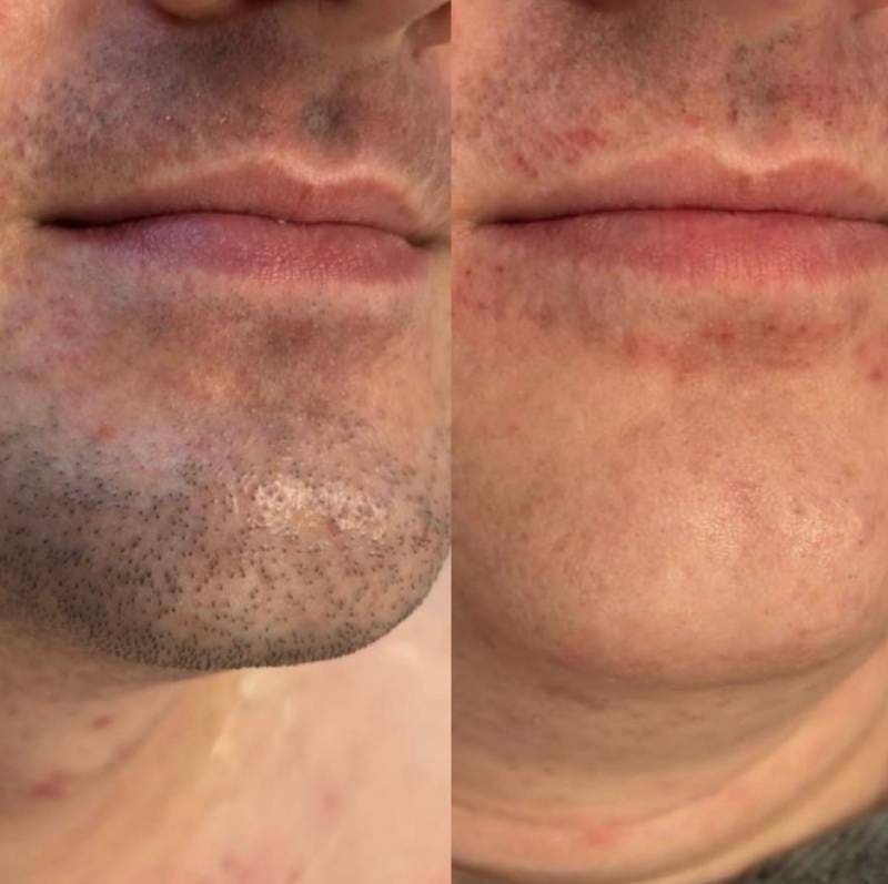 Top 5 Areas People Get Laser Hair Removal And Why