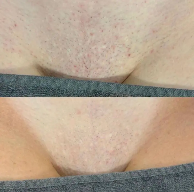 Top 5 Areas People Get Laser Hair Removal And Why