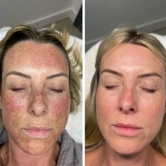 🔥 Reveal Radiant, Youthful Skin with Photofabulous™ at The Laser Club Cheshire
