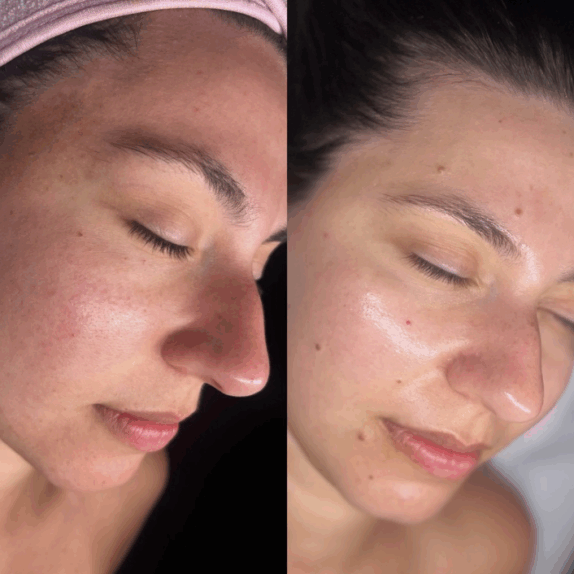 Acne Treatment for Cheshire and Manchester | The Laser Club