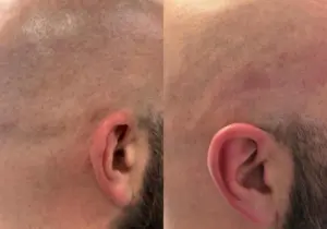 Top 5 Areas People Get Laser Hair Removal And Why