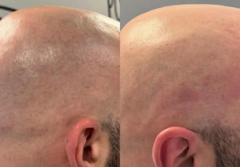 Top 5 Areas People Get Laser Hair Removal And Why