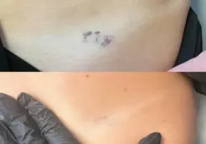 Laser Tattoo Removal