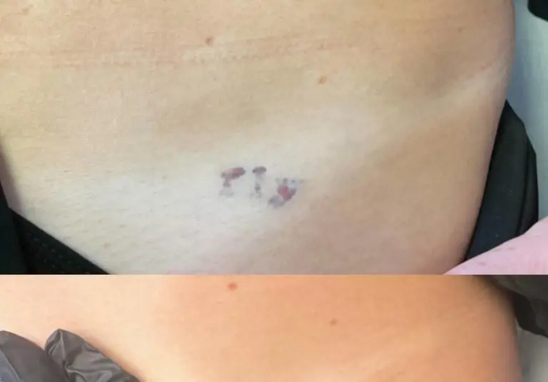 Laser Tattoo Removal
