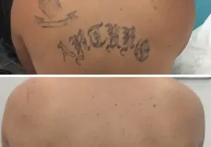 Laser Tattoo Removal