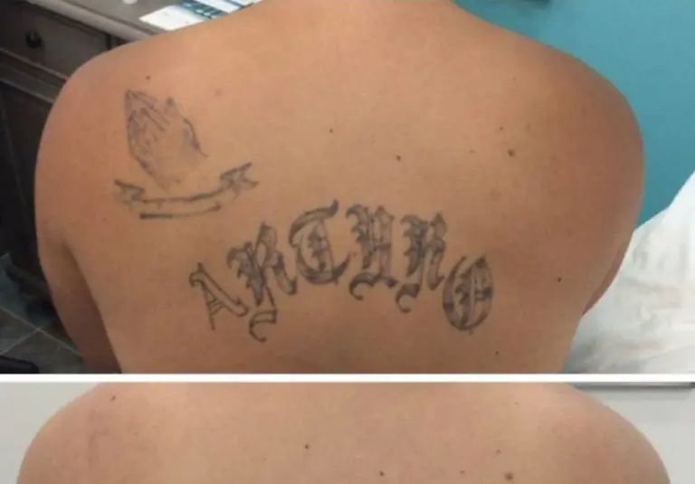 Laser Tattoo Removal