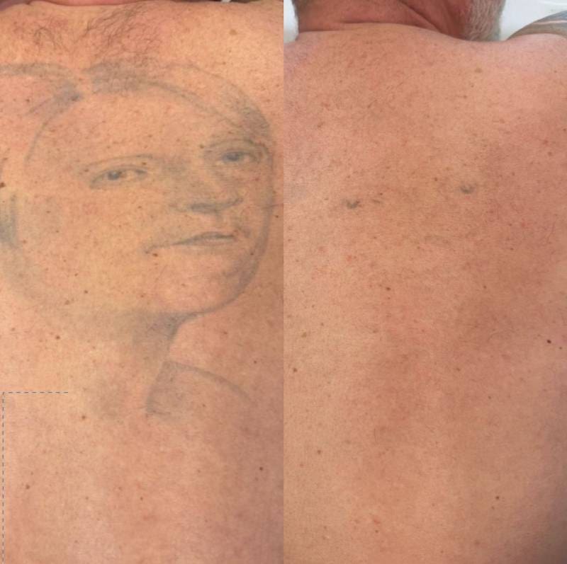 2 sessions of removal