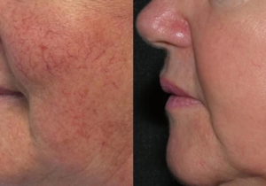 Best Place for Sun Damage in Cheshire
