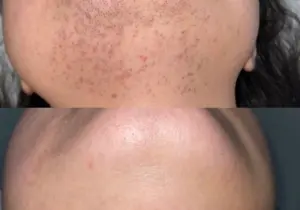 completed chin package