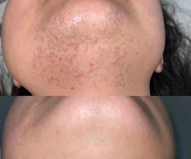 completed chin package
