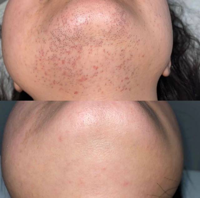 completed chin package