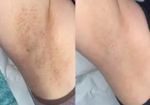 6 sessions underarms