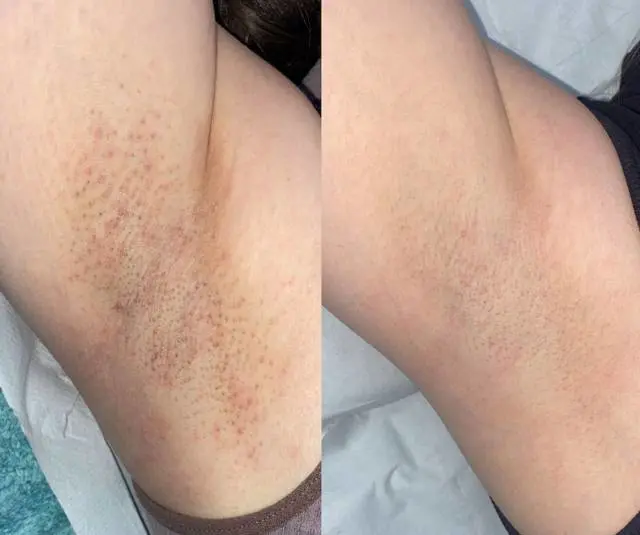 6 sessions underarms