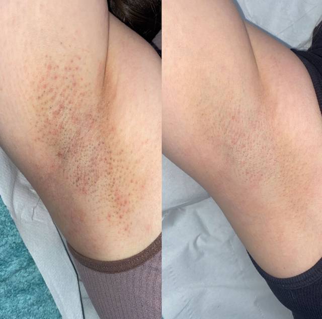 6 sessions underarms