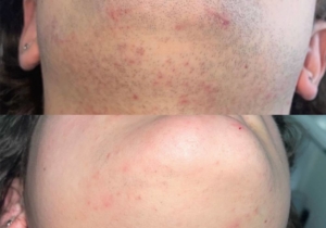 Why You Should Use Primelase for Your Laser Hair Removal
