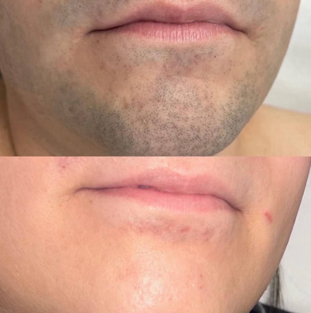 Completed Half Face Package